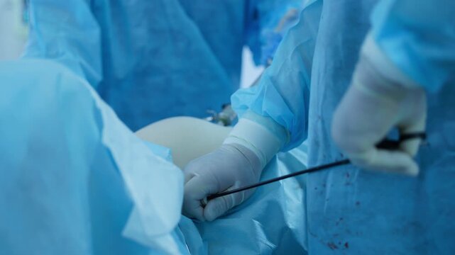 Closeup of surgeons manipulating laparoscopic instruments over patient abdomen in operating room.