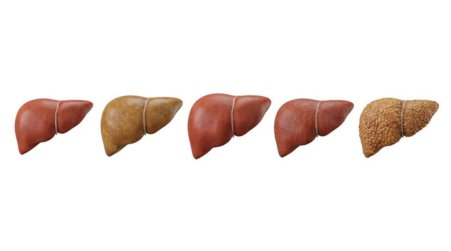 Human liver anatomy showing stages of liver disease from healthy to fatty liver and cirrhosis on white background
