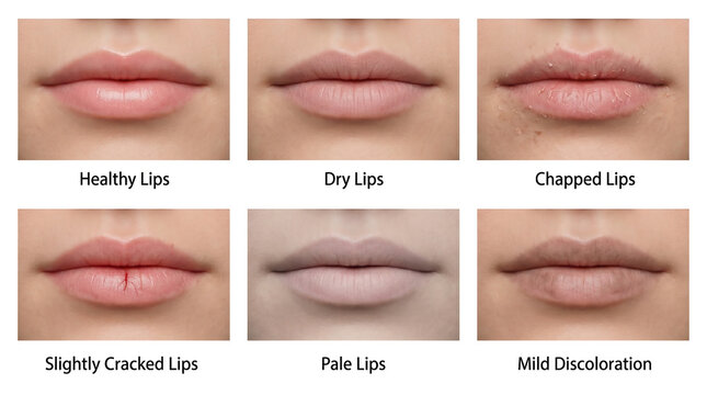 Lip health comparison chart showing healthy, dry, chapped, cracked, pale, and discolored conditions