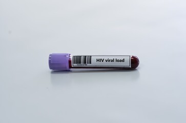 Fototapeta premium Blood sample tube for HIV viral load test analysis.