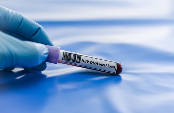 Blood sample tube for HBV DNA viral load test analysis.
