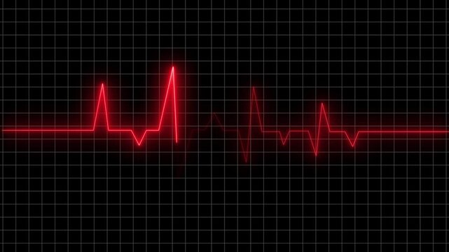 Electrocardiogram displaying irregular heart rhythms on a medical monitoring screen