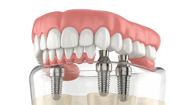 Dental implants supporting a denture with pink gum and white teeth are shown in a medical illustration.