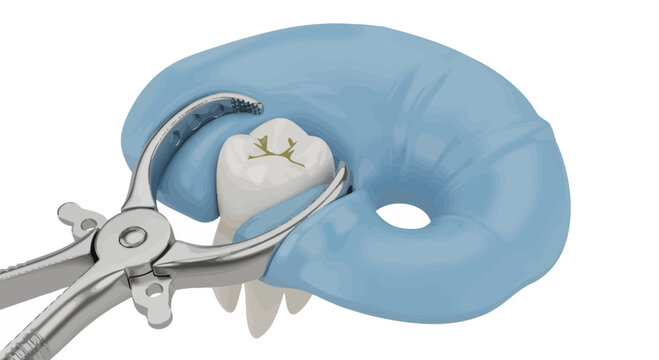 Dentist uses extraction forceps on a tooth with a blue rubber dam