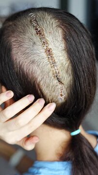 Woman with visible surgical scar after brain cancer surgery. Brain tumor treatment, oncology recovery and survival concept.