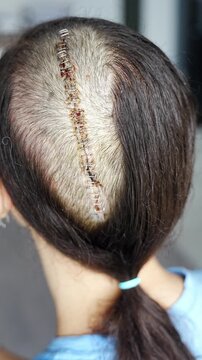 Close up of surgical scar with staples on head after craniotomy for brain tumor removal. Neurosurgery recovery and postoperative healing concept.