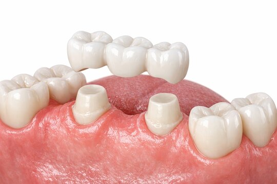 Dental bridge placement over prepared teeth in realistic style. Ai generative