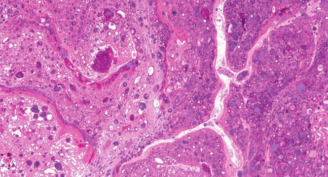 High magnification liver tissue with pigment linked pathological alterations and abnormal cells stained with haematoxylin and eosin