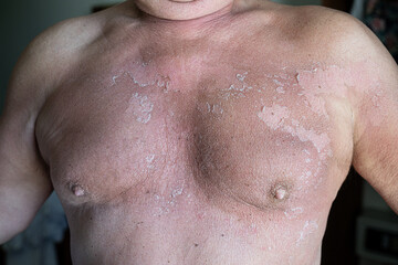 Naklejka premium Peeling sunburned chest skin in summer sun showing flaking redness and textured torso revealing damaged epidermis and discomfort