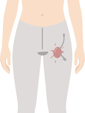 Jock Itch Images – Browse 470 Stock Photos, Vectors, and Video | Adobe ...