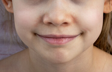 Close up of childs face with weathered skin and chapped lips. Sensitive skin to wind and cold weather. Atopic dermatitis. Baby skin care. Health care