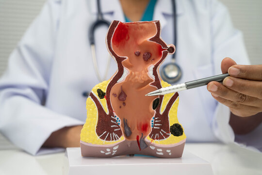 Asian doctor with rectum and hemorrhoid human model, inflamed vascular structure.