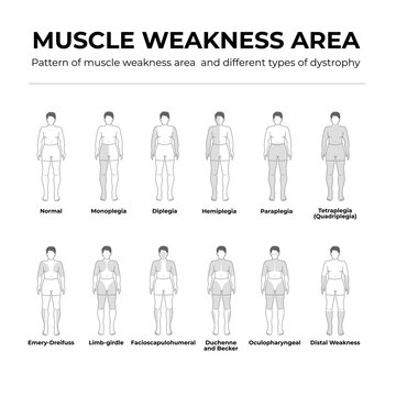 10_pattern of muscle weakness area and different type of dystrophy flat line illustration