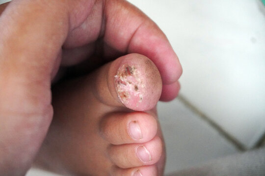 Close-up of common wart or verruca plantaris lesion on a child's toe. Dermatological skin condition, infection caused by human papillomavirus HPV, medical photography.