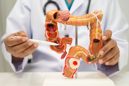 Colorectal cancer, doctor holding intestine colon human anatomy model.