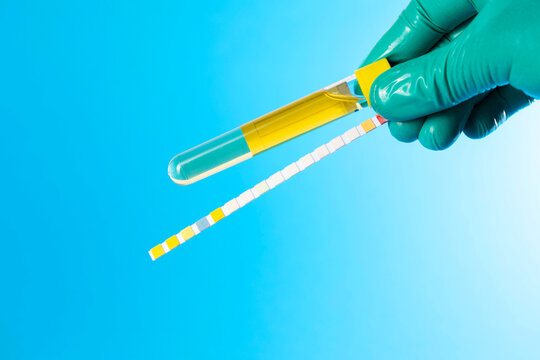 A lab technician's hand, wearing a medical glove, holds a urine culture tube and a urine pH test strip against a blue background. Concept of urine testing and analysis for infections. Copy space for