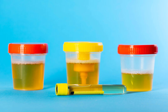 A urine test tube against the background of urine containers for testing for alpha amylase and microalbuminuria, a highly accurate test for early diagnosis of diseases. Copy space for text