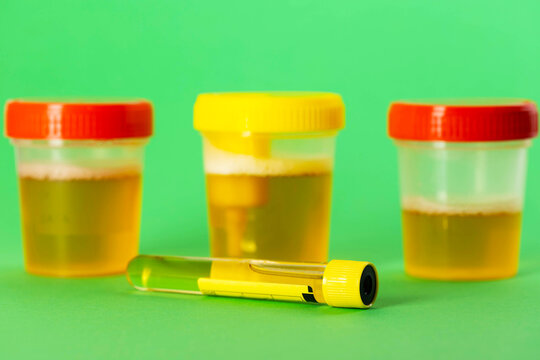 A test tube with urine against a green background, next to a three-glass urine sample. Concept for urine testing for infections causing pyelonephritis, urethritis, and cystitis, close-up