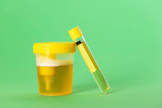 A test tube with reagent and urine on a green background. Bacterial culture for Enterobacteriaceae and Staphylococcus saprophyticus bacteria, which cause pain and inflammation in the urinary tract