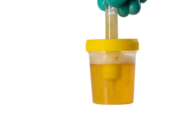 Transferring urine into a transport tube with reagents for bacterial culture testing, white background. Diagnosis of bacterial infections and microorganisms with antibiotic sensitivity. Copy space for