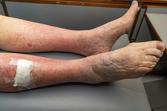 Elderly patient with vasculitis in the legs due to an adverse reaction to atenolol.