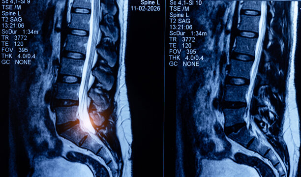 Sagittal lumbar spine mri scan with highlighted disc region for clinical diagnosis of herniation and nerve compression, medical reports