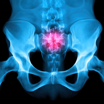 Ultra realistic X-ray of sacrum with highlighted red pain point, medical illustration of tailbone injury pain showing inflammation, trauma and diagnostic healthcare imaging