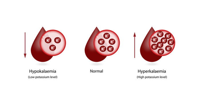 Hyperkalaemia, high plasma potassium level and Hypokalaemia, low plasma potassium level. Potassium K excess and deficit electrolyte disorders, blood test tube, Scientific design. Vector illustration