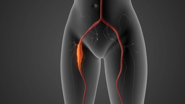 Peripheral arterial disease causing leg pain
