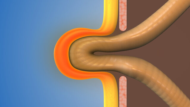 Hernia Bulge Forming in Abdomen Area