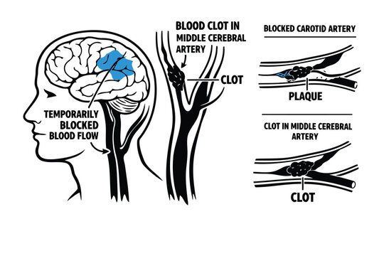 Medical illustration showing different causes and locations of blood clots in the human brain area Vector