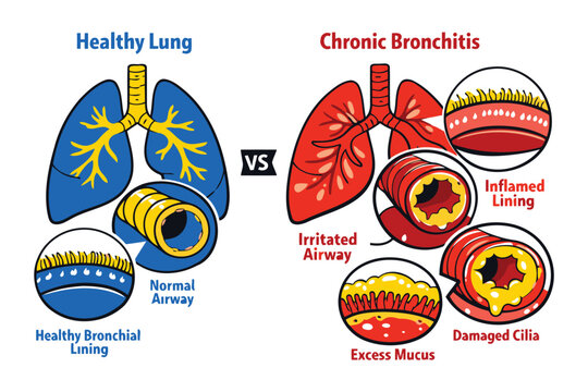 A comparative medical illustration of a healthy lung versus a lung suffering from chronic bronchitis Vector