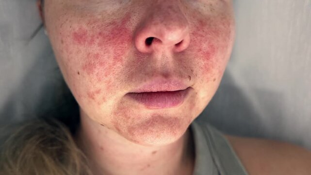 Close-up of a young womans face with visible skin irritation and redness. Inflamed, dry, and textured skin. Concept of sensitive skin, allergy, inflammation, and skincare problems