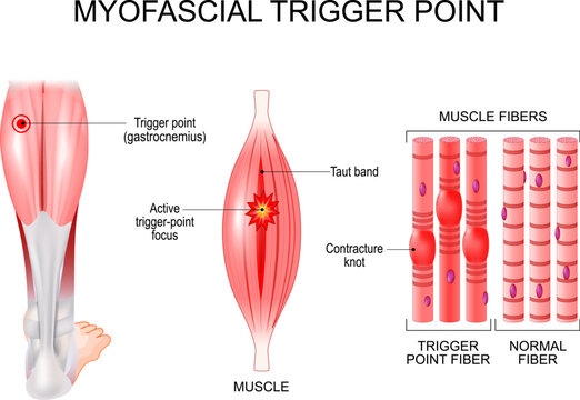 Myofascial trigger point in leg. Muscle fibers with contracture knots and taut band