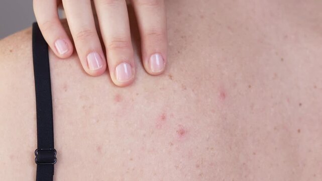 Close up of female back showing acne with inflamed rashes and red pustules. Rash condition highlights irritation and uneven skin texture in natural dermatology context with visible inflammation