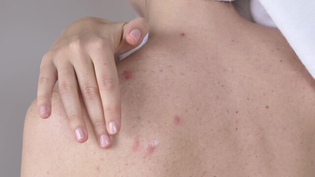 Woman back with acne and rash receiving topical therapy. Inflamed rashes and red pustules show active condition, treatment supports healing and dermatology care
