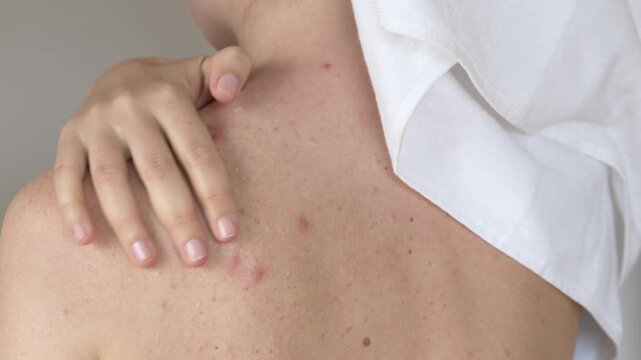 Woman touching back with towel shows acne vulgaris lesions and inflammation. Acne vulgaris condition presented through visible redness and skin texture changes in dermatology context