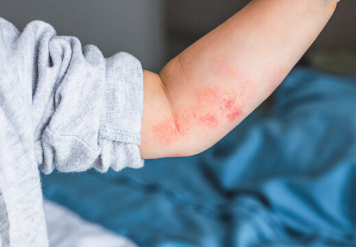 small hand of child covered by eczema. allergy baby skin dermatitis food. Unrecognizable dermatitis symptom problem rash. concept child health and care