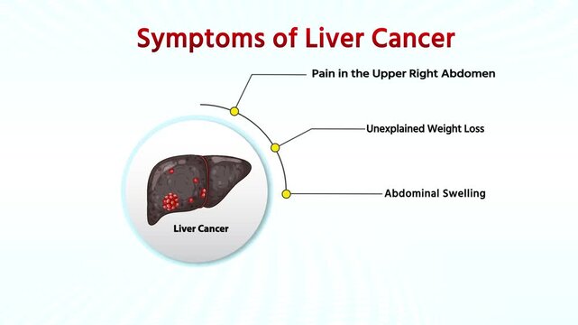  Symptoms Liver Cancer . Infographic Medical Animation