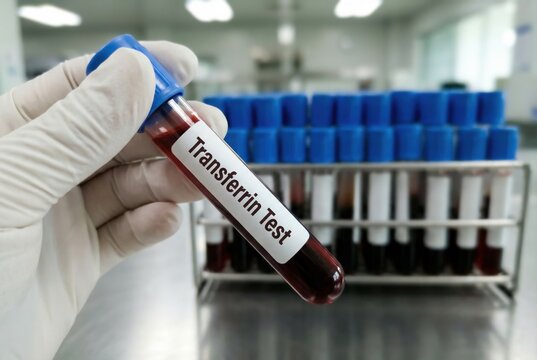 Blood sample tube labeled "Transferrin Test" in laboratory, medical diagnostics, healthcare research, clinical testing