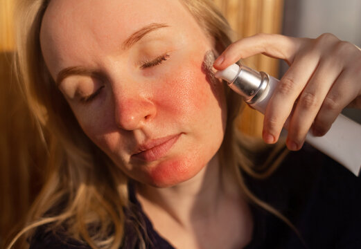 Gentle skincare for sensitive skin with rosacea and couperose: anti-redness serum to soothe or after sunburn. Concept of treatment, recovery, and daily facial skin care routine.