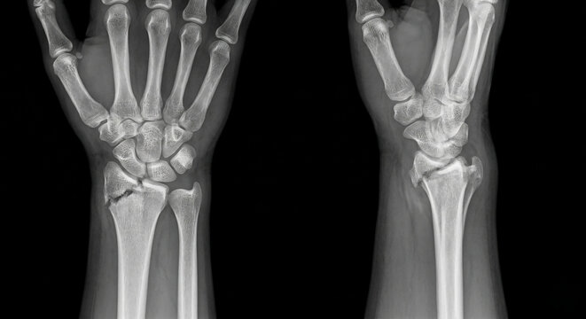 X-ray radiograph of a human wrist bone fracture showing a distal radius break in anterior-posterior and lateral views.