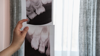 Black and white dental X-ray showing upper teeth and roots. Concept of dentistry, oral health, medical diagnostics, and dental care © leroy