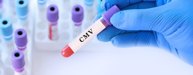 Fototapeta premium Doctor holding CMV blood test tube explaining detection of cytomegalovirus infection, immune response evaluation and viral diagnostics in clinical laboratory testing