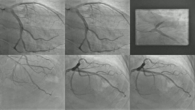 Normal Coronary Angiogram Fluoroscopy main Views Left Coronary Arteries Medical Imaging Video