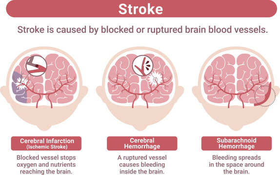 Stroke types medical infographic brain infarction cerebral hemorrhage subarachnoid hemorrhage explanation(English Labels)