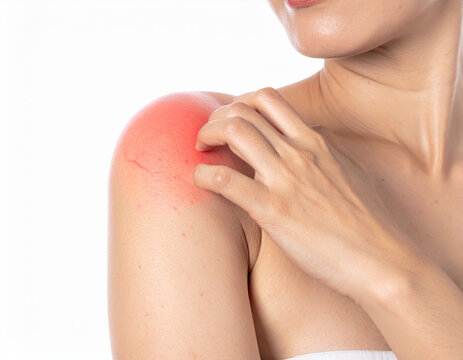 woman scratching her itchy red shoulder due to skin allergy, rash, or insect bite on white background.