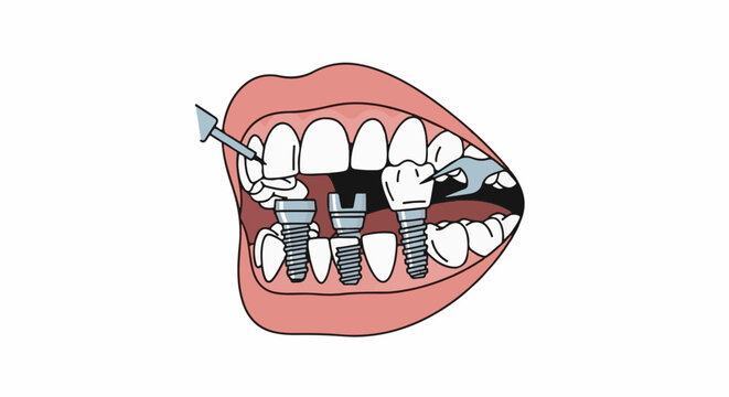 Dental implants being placed in mouth with tools