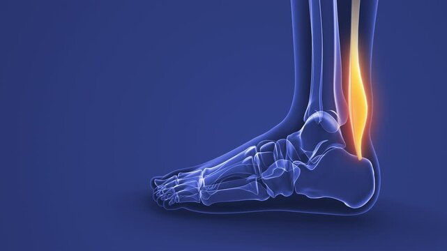 Achilles Tendon Strain Causing Ankle Pain