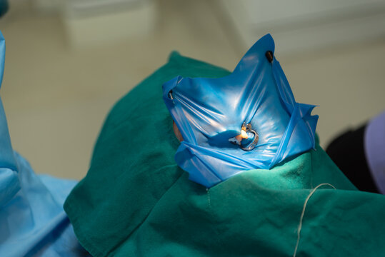 tooth extraction during dental surgery with rubber dam isolation and surgical tools sterile clinical environment oral healthcare treatment closeup detail